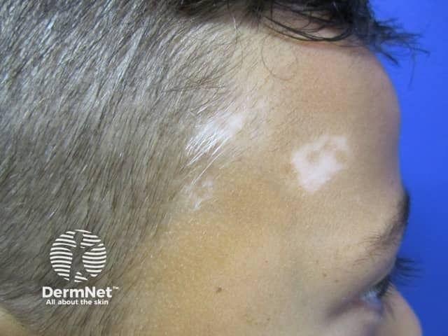 Oral Silymarin Plus Hair Follicle Transplantation Efficacious in Refractory Vitiligo