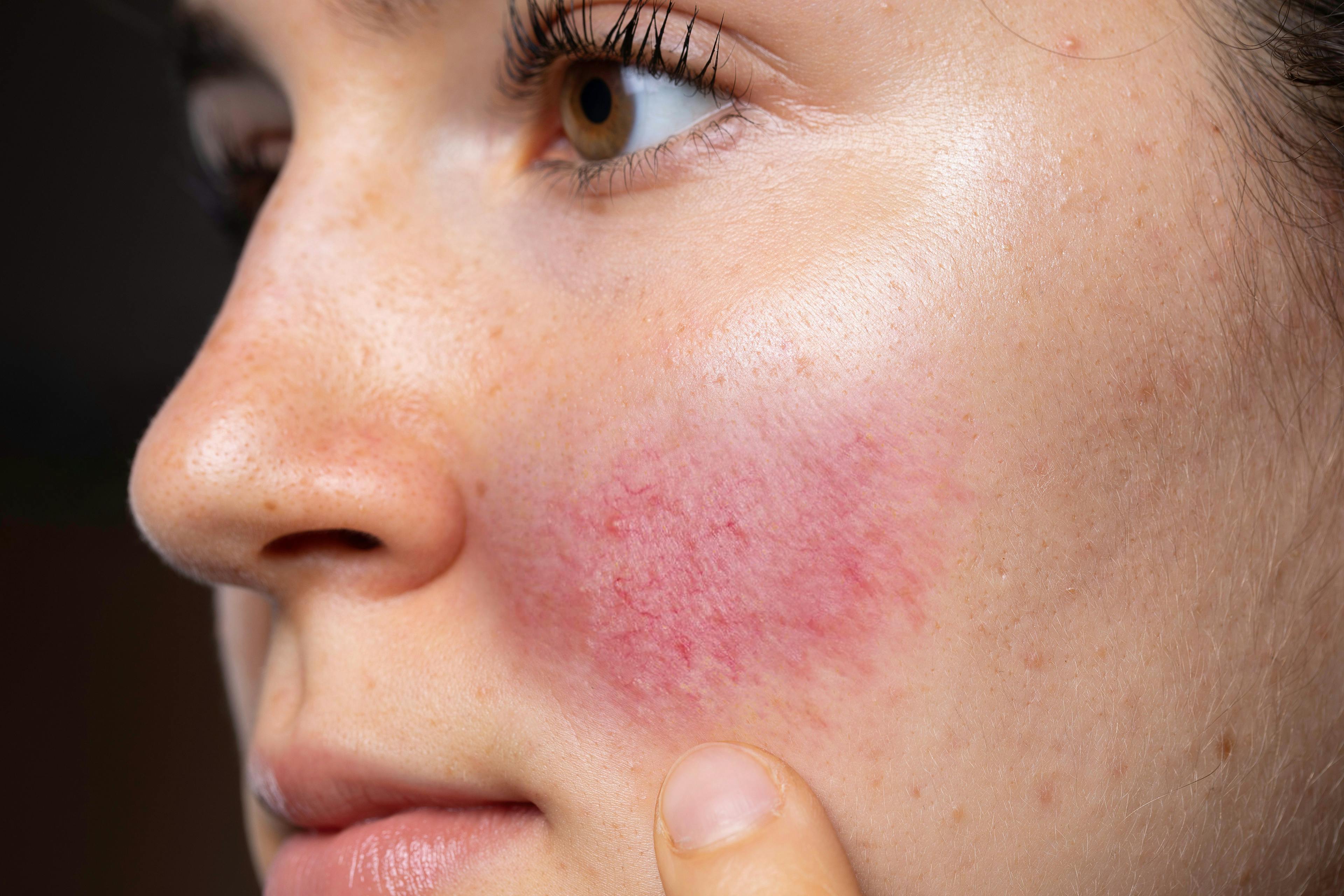 Patient with rosacea | Image Credit: © Alessandro Grandini - stock.adobe.com