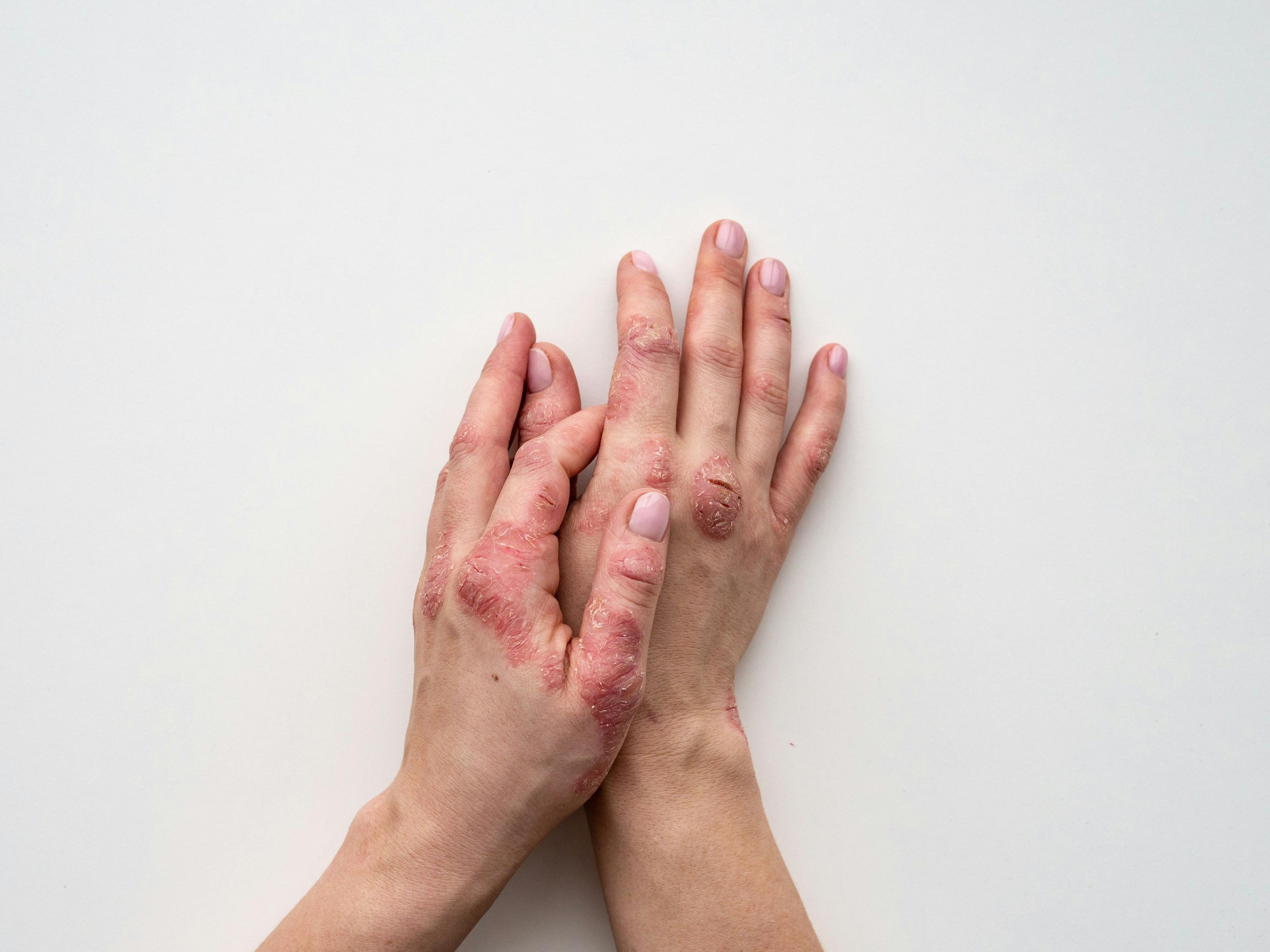 Patient with psoriasis on hands | Image Credit: © IIIRusya - stock.adobe.com