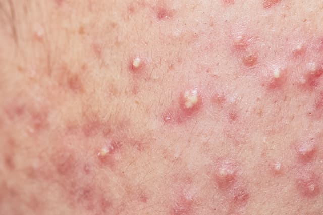 Study Reveals Comparable Efficacy of Clascoterone, Trifarotene, and Tazarotene in Acne Treatment