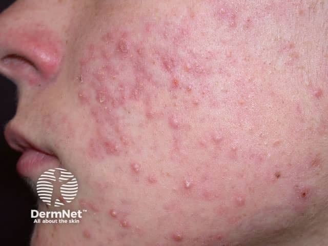 Face with acne vulgaris | Image Credit: © dermnetnz.org