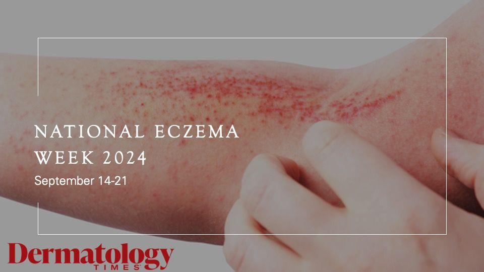 Spotlighting National Eczema Week 2024 