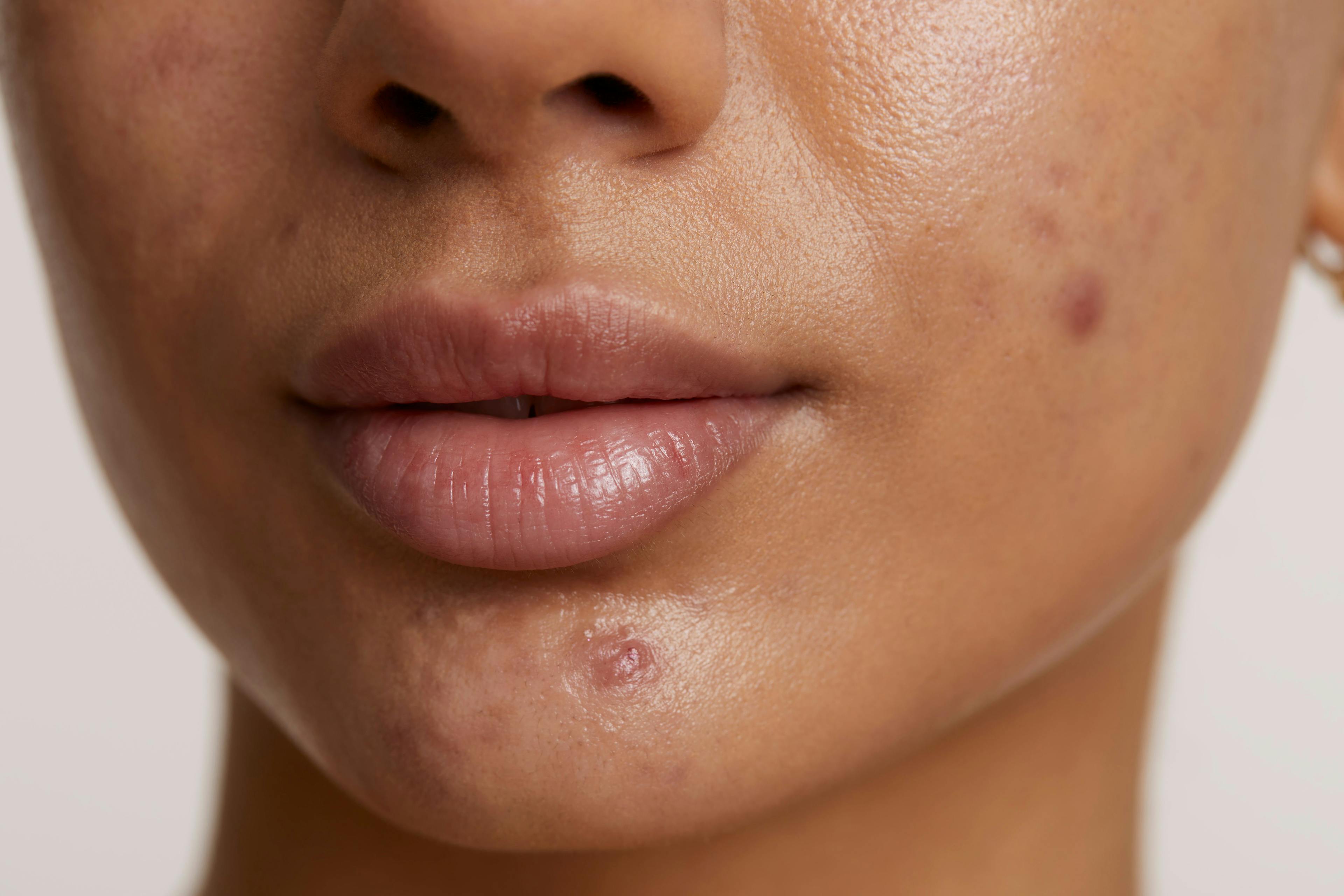 Study Examines Psychological Comorbidities Among Acne Patients Using Isotretinoin