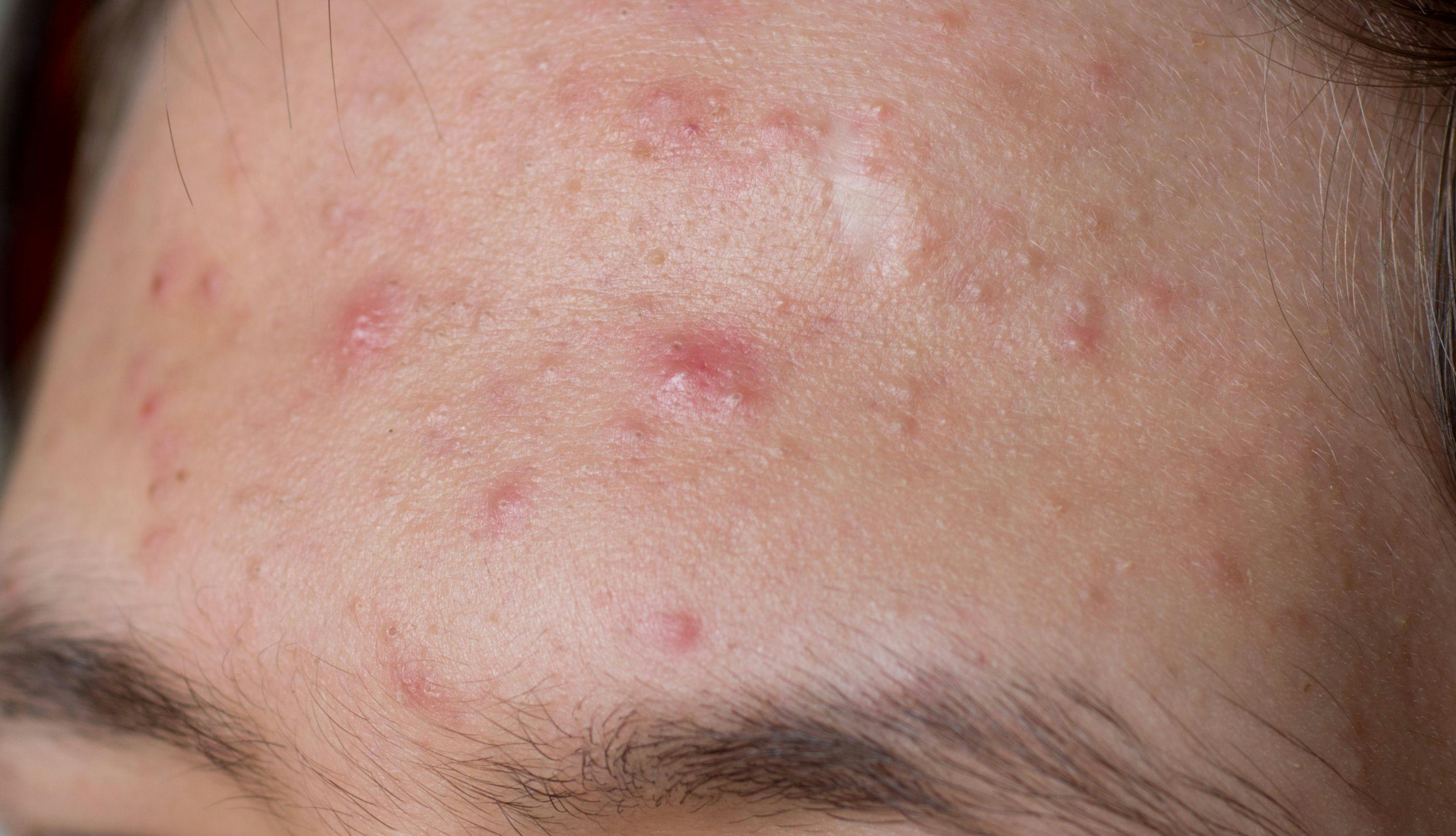 Close up view of acne on the forehead