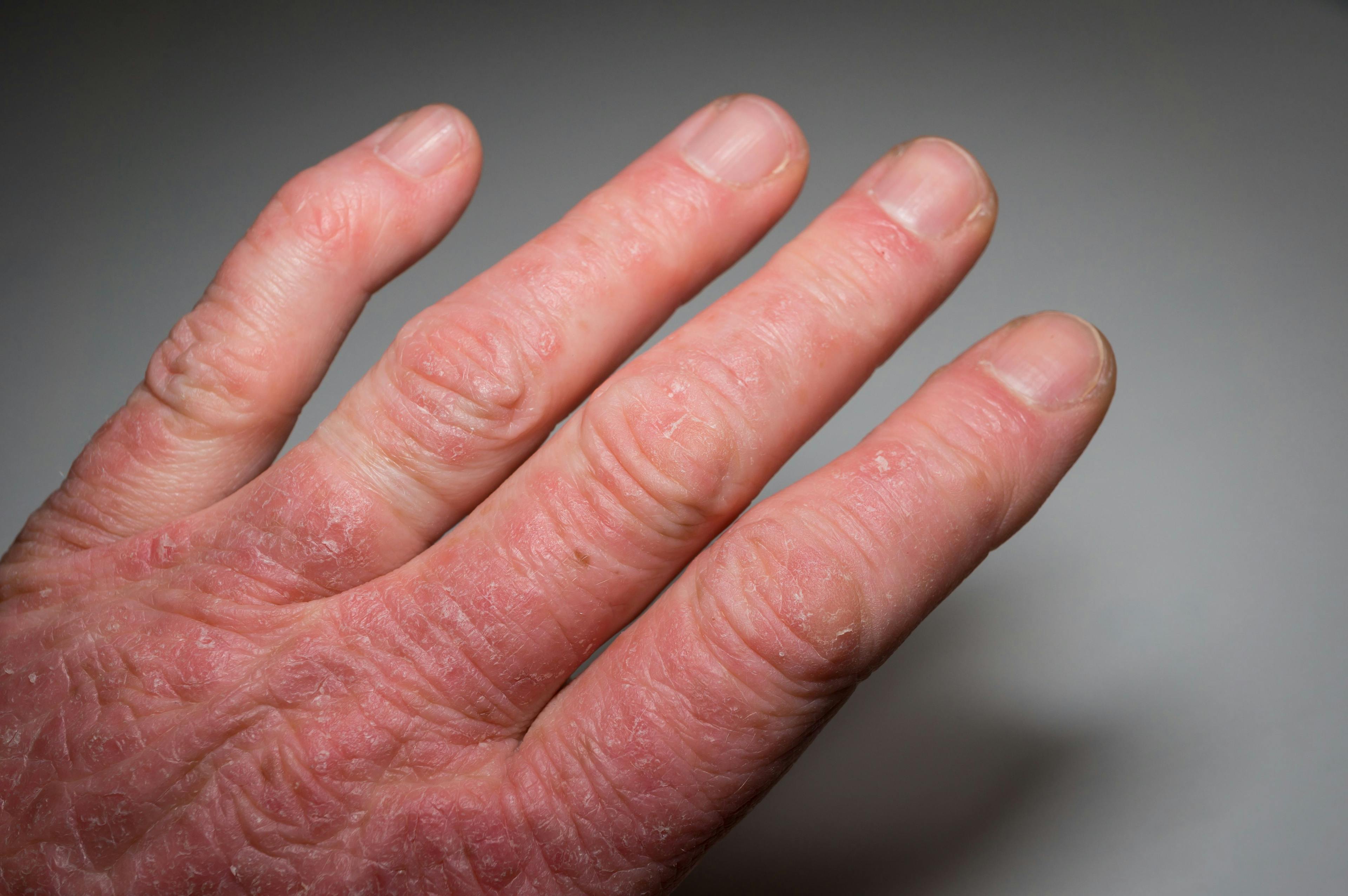 In Psoriatic Arthritis, Psychosocial Factors Significantly Increase Risk of Joint Pain